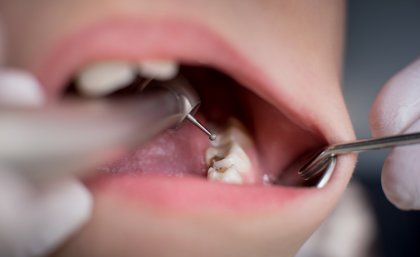 Open child's mouth with dental equipment visible inside 